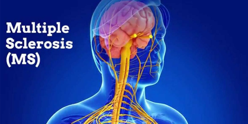 multiple sclerosis nvmx template