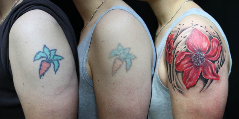 tattoo removal uzyq template