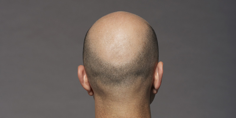 hair loss kpyl template